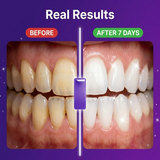 רצועות הלבנה סגולות של Smilevo — לשיניים רגישות, תוצאות תוך 7 ימים